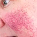 Natural Remedies For Rosacea