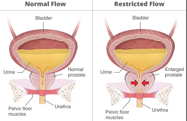 Remedies For Slow Urine Flow