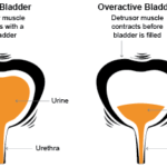 Natural Remedies For Overactive Bladder at Night