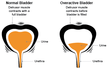 Remedies For Overactive Bladder at Night