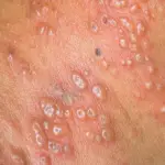 Natural Remedies For Shingles
