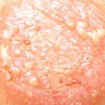Natural Remedies For Ringworm